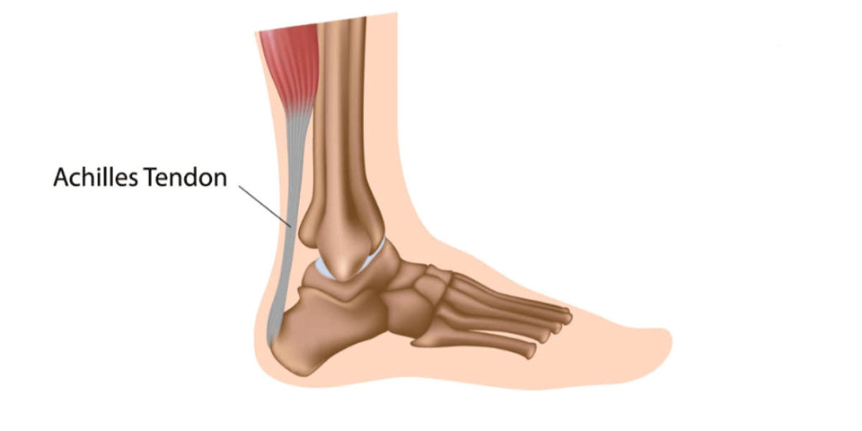 Achilles-tendonitis